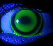 Contact lens Fitting exam