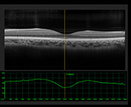 Dilated Retinal Exam