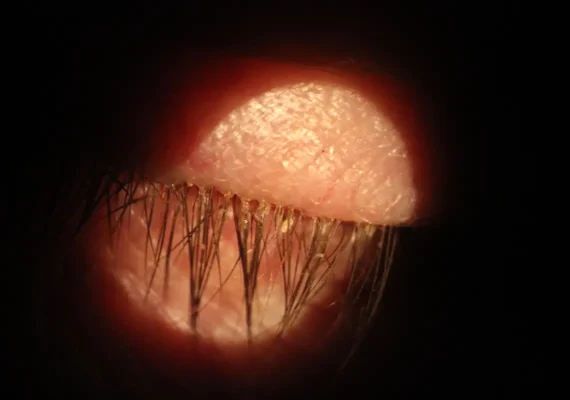 Demodex Blepharitis (1)
