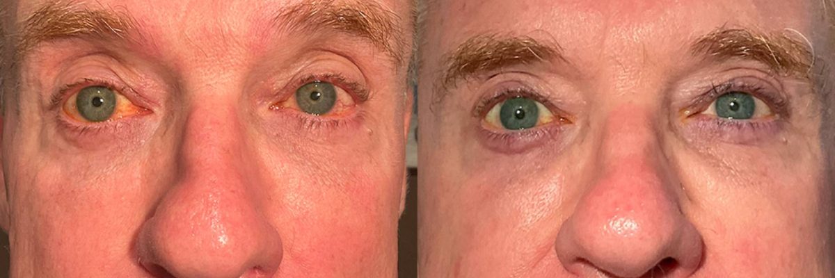 Envision_Lumecca & Forma_Cheeks_Before & After2 (1)